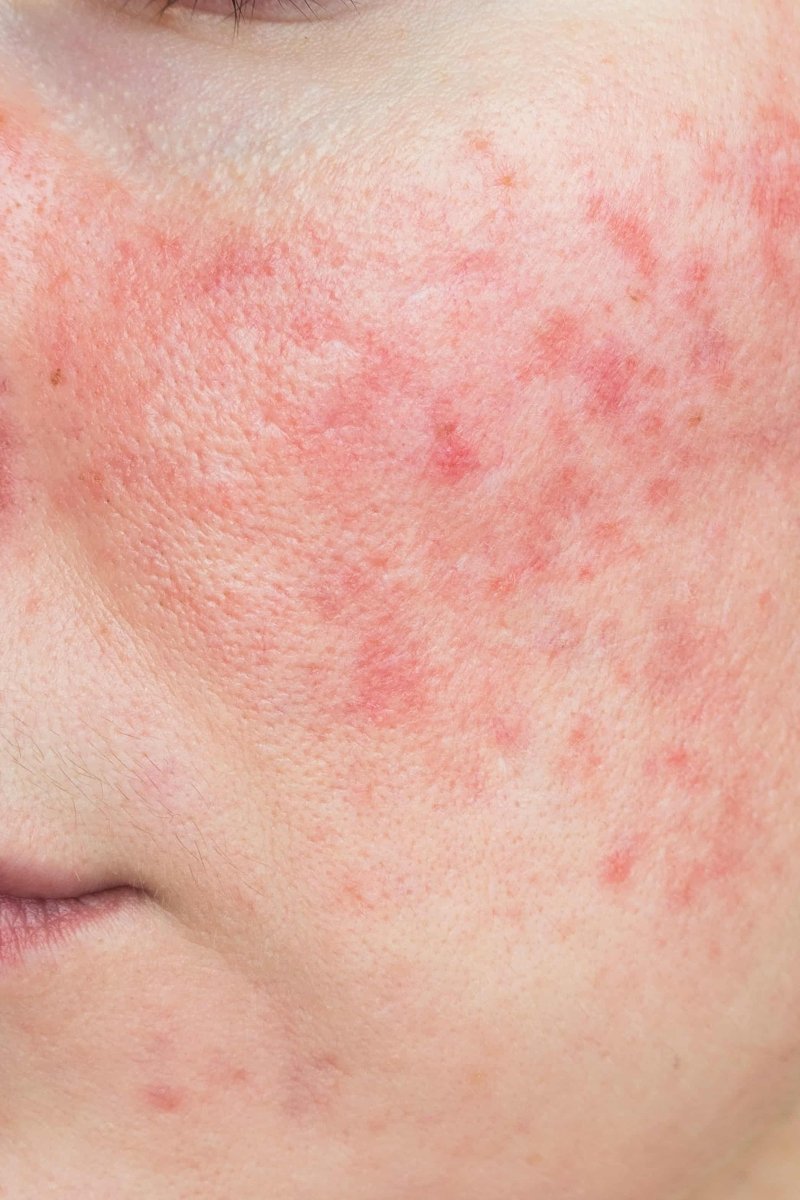 What’s your problem: Rosacea - Eco By Sonya Australia