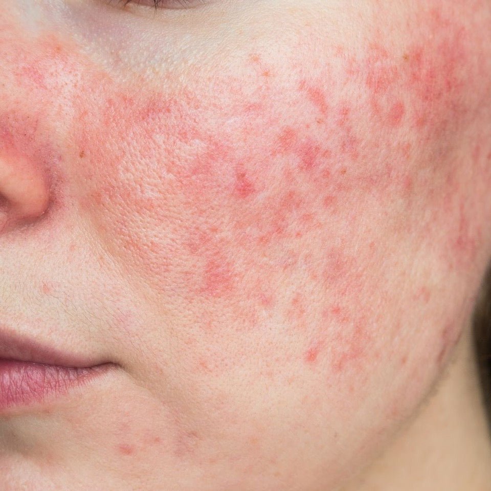 What’s your problem: Rosacea - Eco By Sonya Australia
