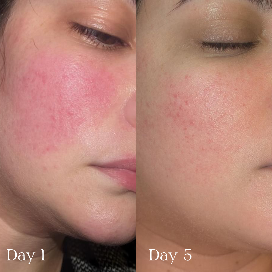 Before and after comparison of a person's face with visible skin conditions on Days 1 and 5.