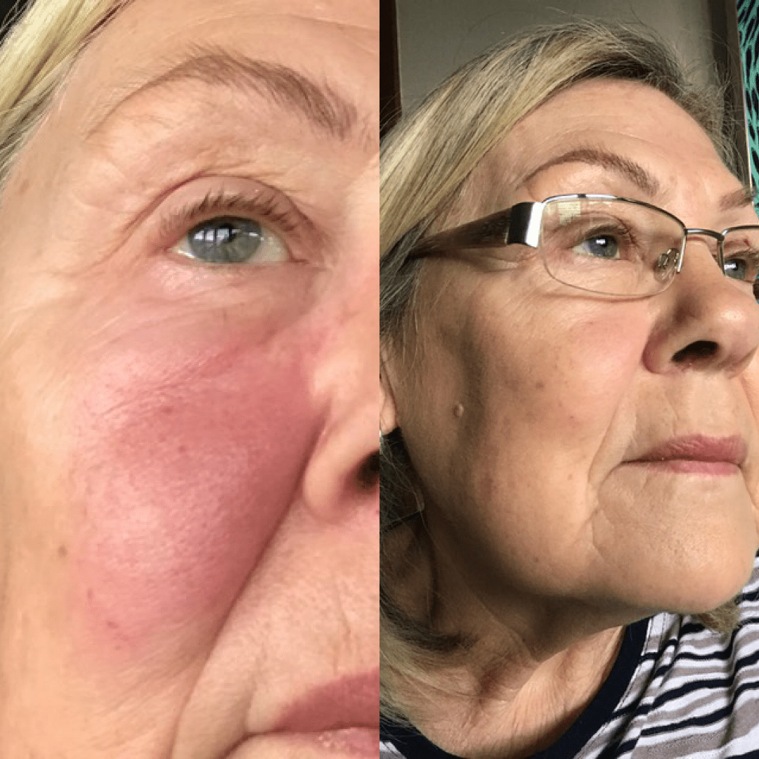 Rosacea before after results on face, reduced redness