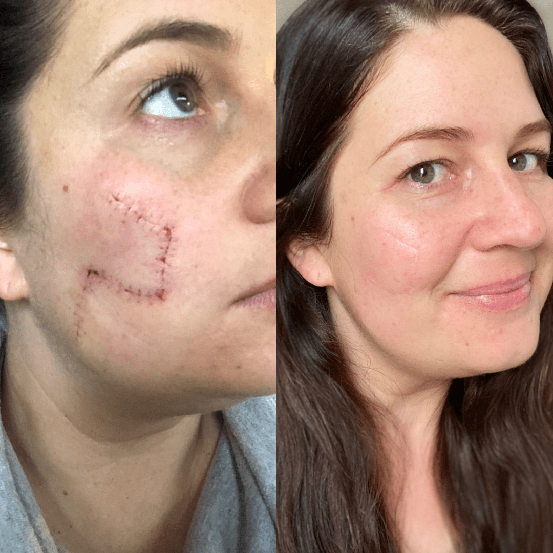 Scarring before and after results from organic Glory Oil