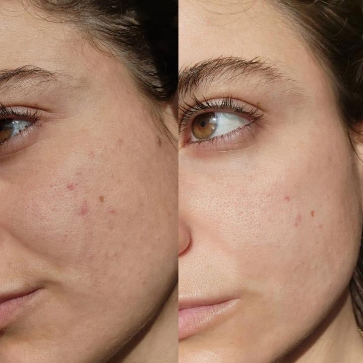 Comparison of a woman's face with acne on the left side and clear skin on the right side before and after using serum of clear