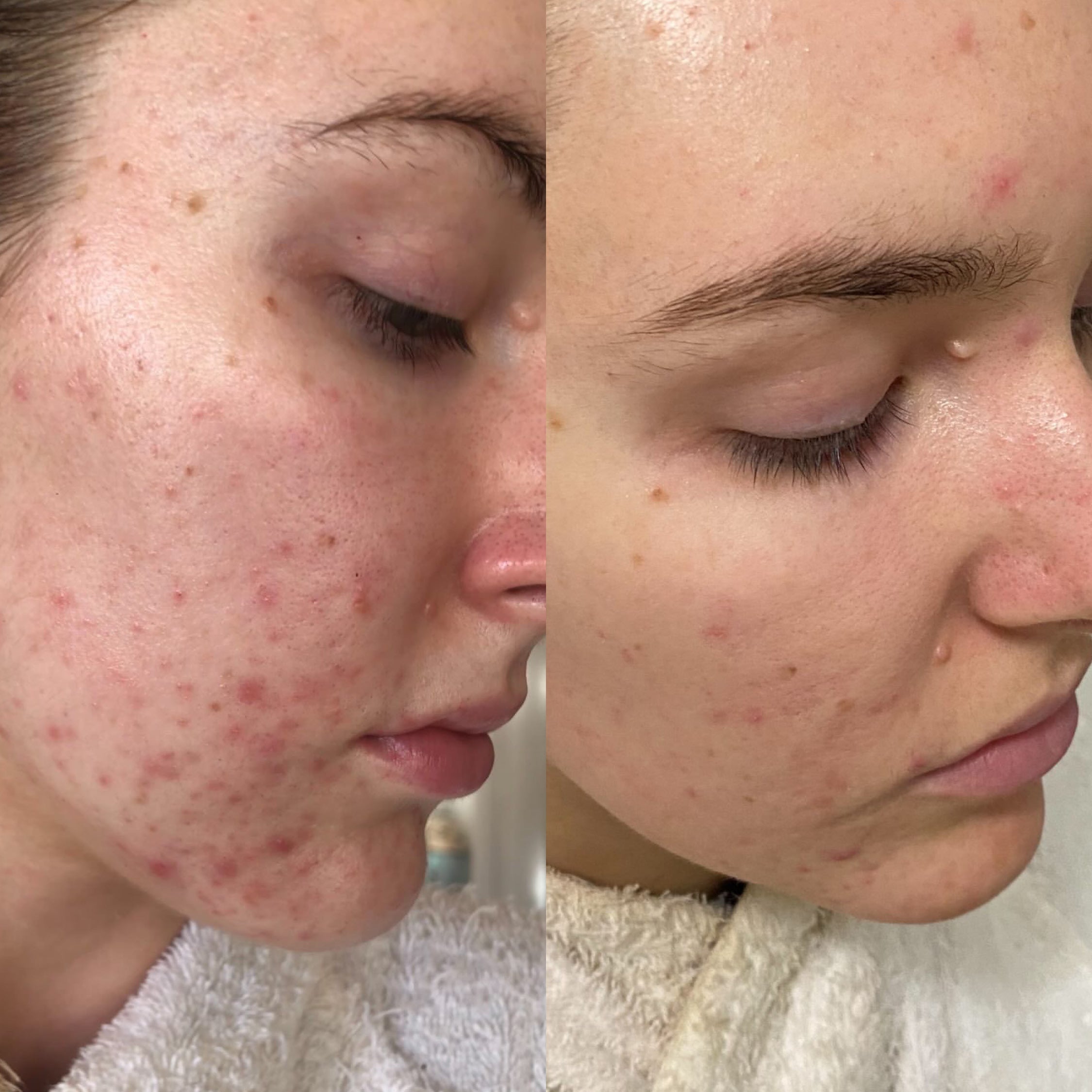 Comparison of a person's face with acne before and after using Super Citrus Cleanser on a neutral background